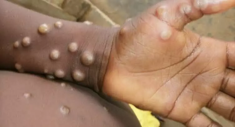 Task force formed to closely monitor monkeypox menace in India