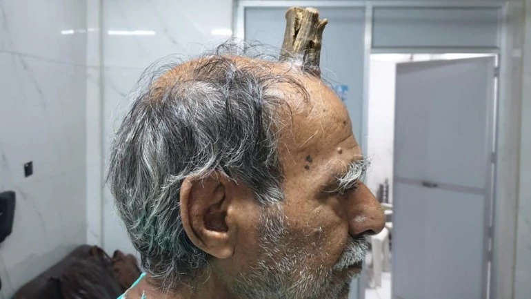 74-year-old MP man grows devil’s horn after injury