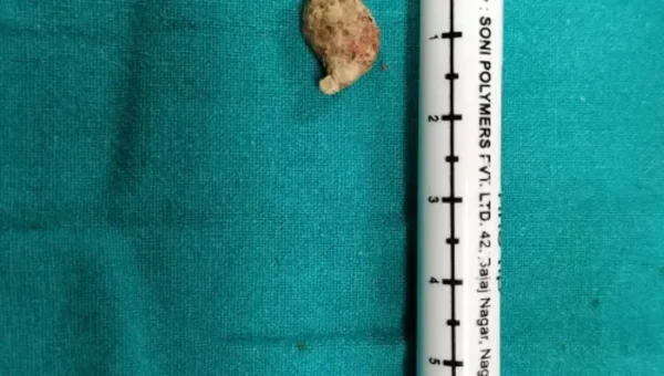 Doctor’s Day Special: Salivary gland stone removal surgery is performed only in GMERS Hospital Gotri