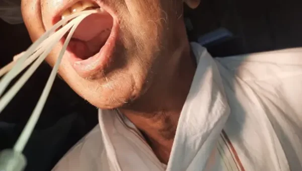 Radiation oncology department of Sayaji Hospital with dental department successfully treated cancerous ulcer of the palate