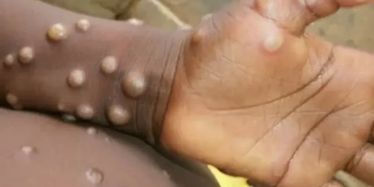 Task force formed to closely monitor monkeypox menace in India