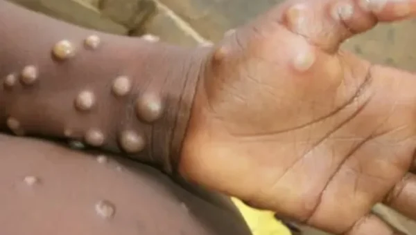 Task force formed to closely monitor monkeypox menace in India