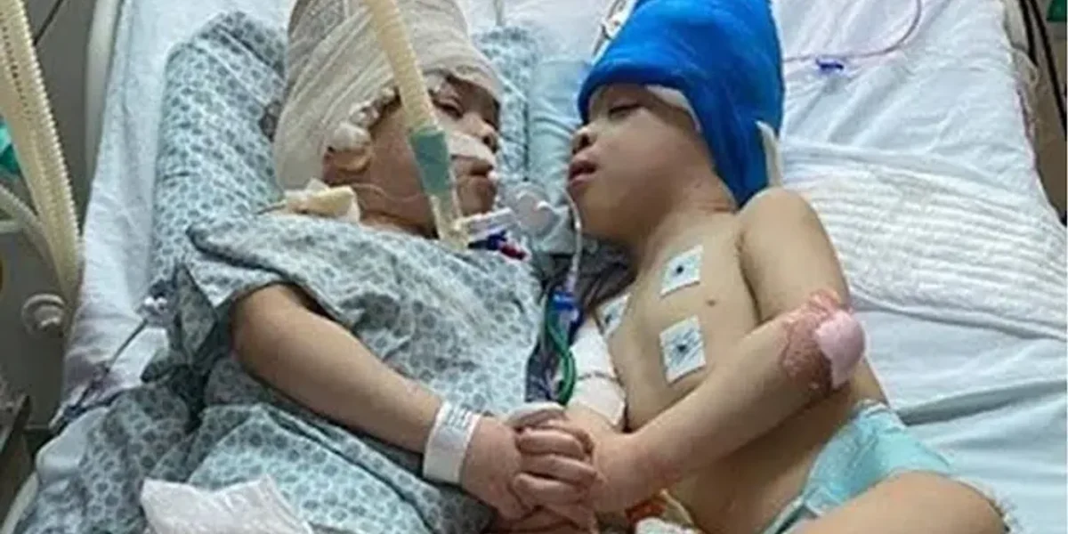 Conjoined twins separated with the help of virtual reality