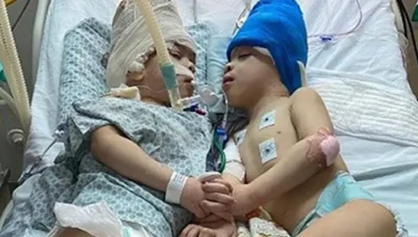 Conjoined twins separated with the help of virtual reality