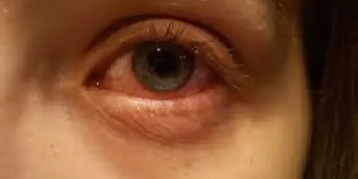 Reports: Karnataka recorded over 40,000 cases of conjunctivitis between July 25 and August 4