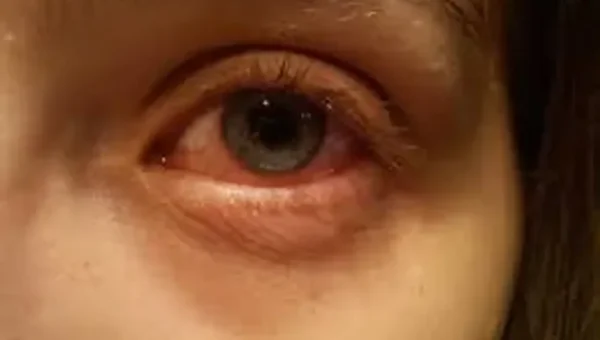 Reports: Karnataka recorded over 40,000 cases of conjunctivitis between July 25 and August 4