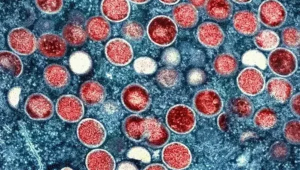 China Mpox cases surge as virus spreads to more parts of country