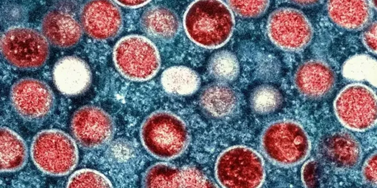 Japan: Health ministry reports country’s first death from mpox