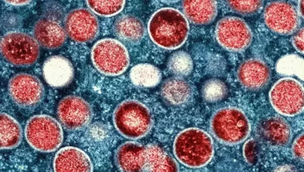 Japan: Health ministry reports country’s first death from mpox