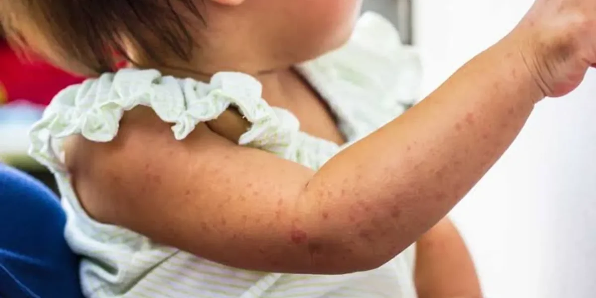 WHO Flags India as major measles hotspot
