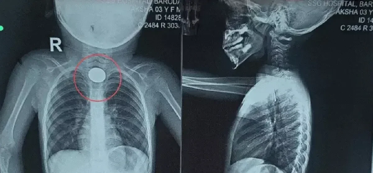 Panic in Vadodara as Two Children Swallow Paper Pin and Coin, Emergency ENT Surgeries Save Lives